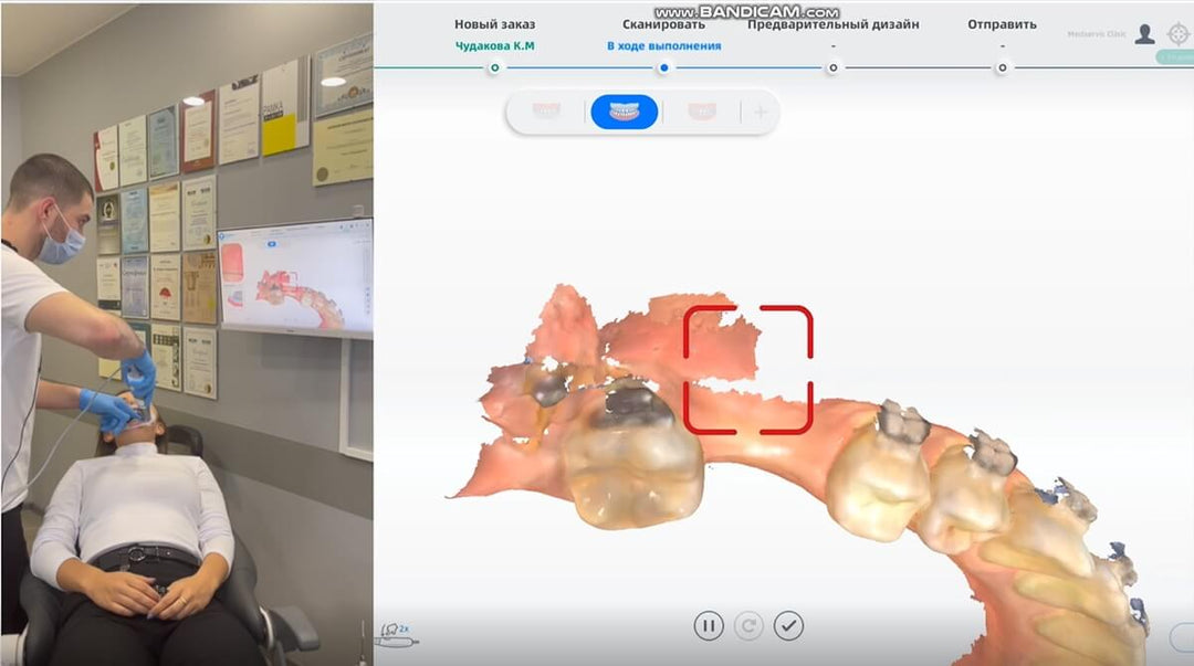 RECISE IMPLANT RESTORATION GUIDED BY DIGITAL SURGICAL GUIDE