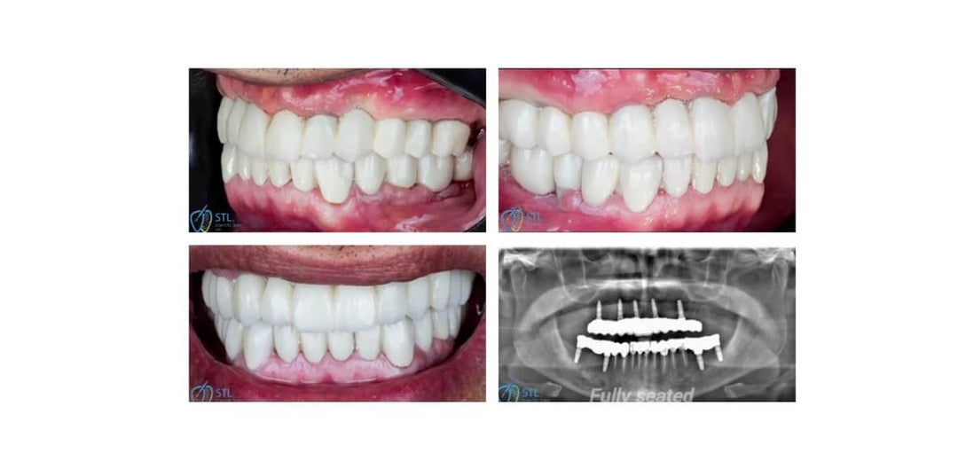 ALL-ON-X AESTHETIC RESTORATION DESIGN DRIVEN BY AORALSCAN ELITE & METISMILE