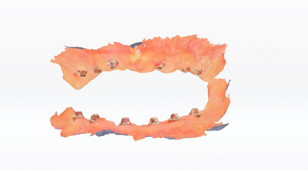 DETERMINE THE ACCURATE BITE FOR EDENTULOUS IMPLANT PATIENTS: CHALLENGES AND MODERN SOLUTIONS