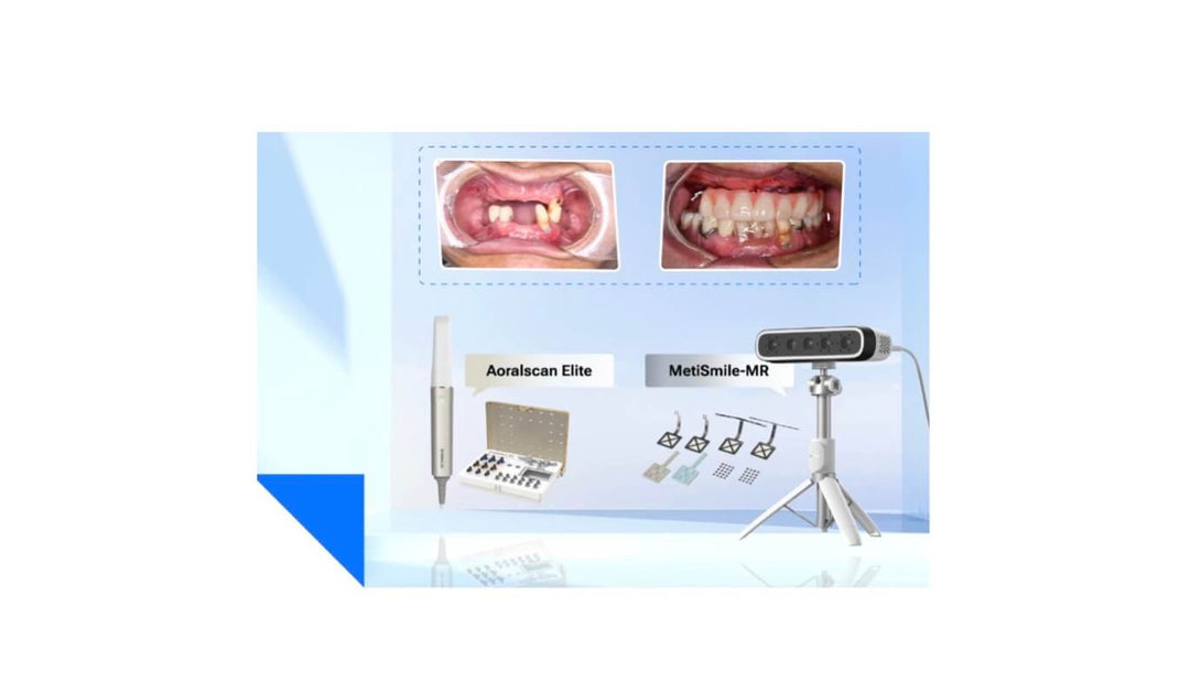Full Arch All-On-Five Implant Prosthesis Case Study Using Aoralscan Elite and MetiSmile-MR