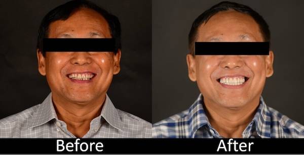 FULL MOUTH REHABILITATION CASE WITH OUR AORALSCAN 3 INTRAORAL SCANNER