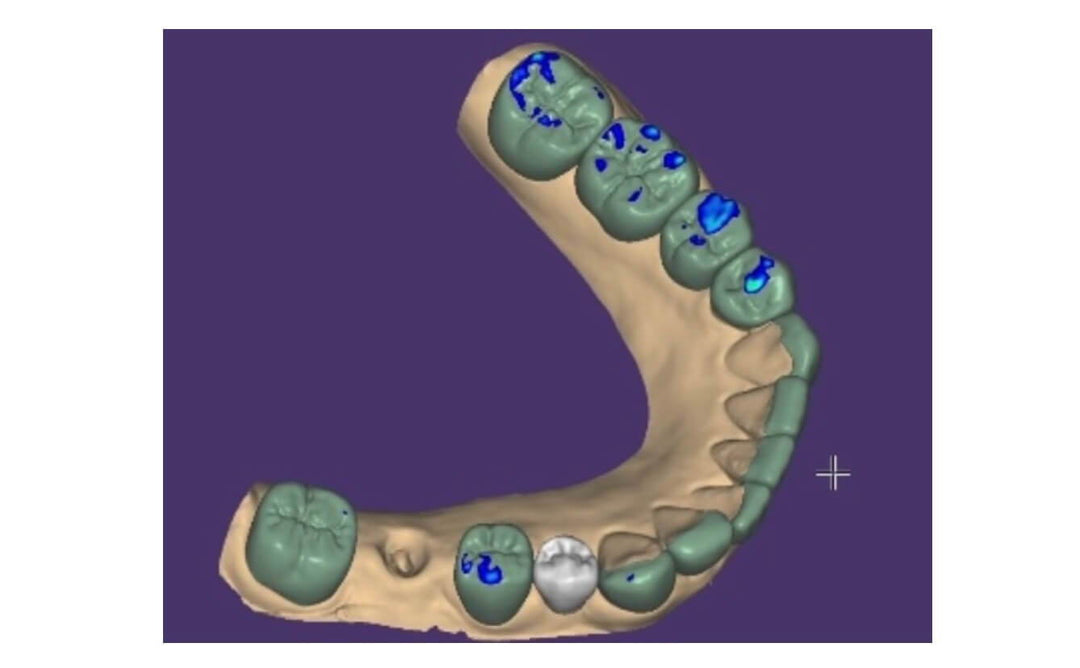 IMPLANT AND VENEER RESTORATIONS FOR THE TREATMENT OF TMJ PAIN USING OUR WIRELESS AORALSCAN 3 INTRAORAL SCANNER