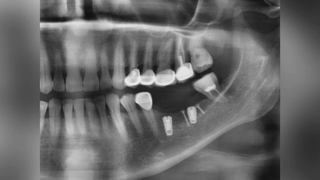 IMPLANT RESTORATION WITH DIGITAL TECHNOLOGY
