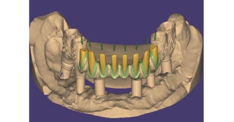 THE RESTORATIONS WITH TORONTO BRIDGE USING OUR AUTOSCAN-DS-MIX DENTAL DESKTOP 3D SCANNER