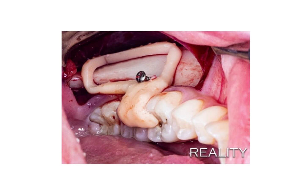 AUTOGENOUS BONE GRAFTING IMPLANT SURGERY WITH DIGITAL TECHNOLOGY