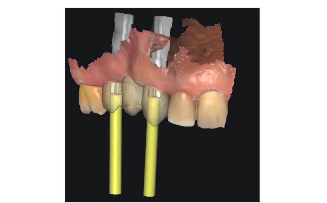 Implant restorations using our Aoralscan3 Intraoral scanner and 3D printer