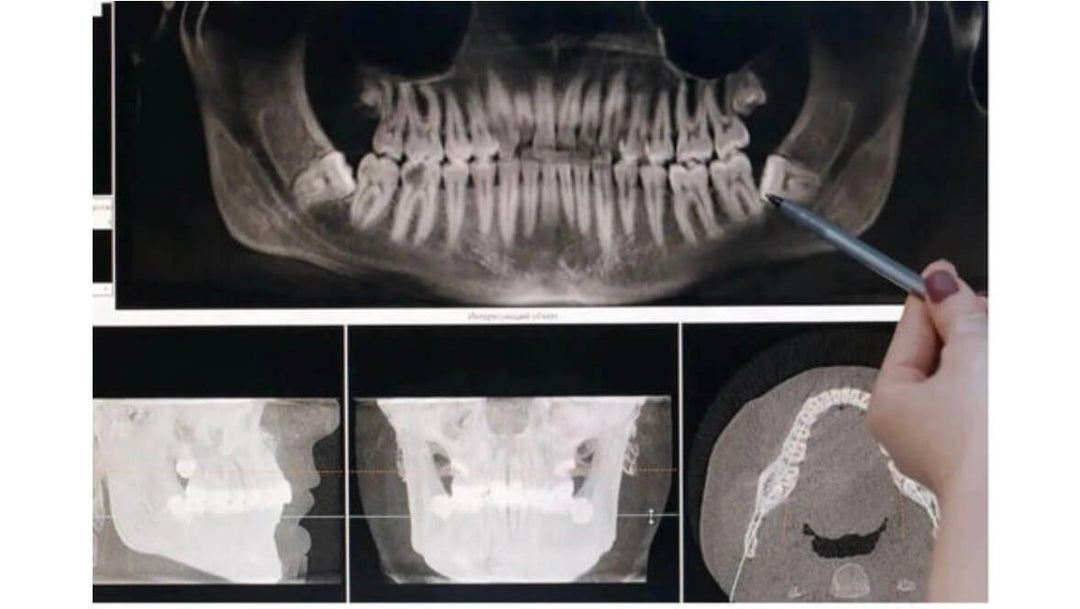 Why is it recommended to use an ultrasonic Piezoelectric bone surgical unit and when to use it?