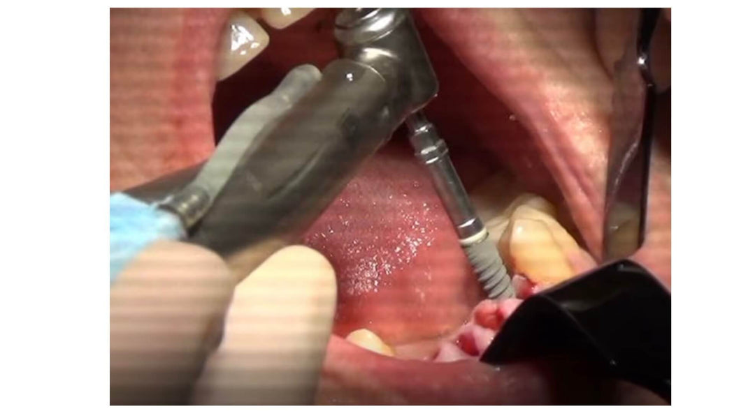 APPLICATION OF AORALSCAN 3 IN IMMEDIATE LOADING