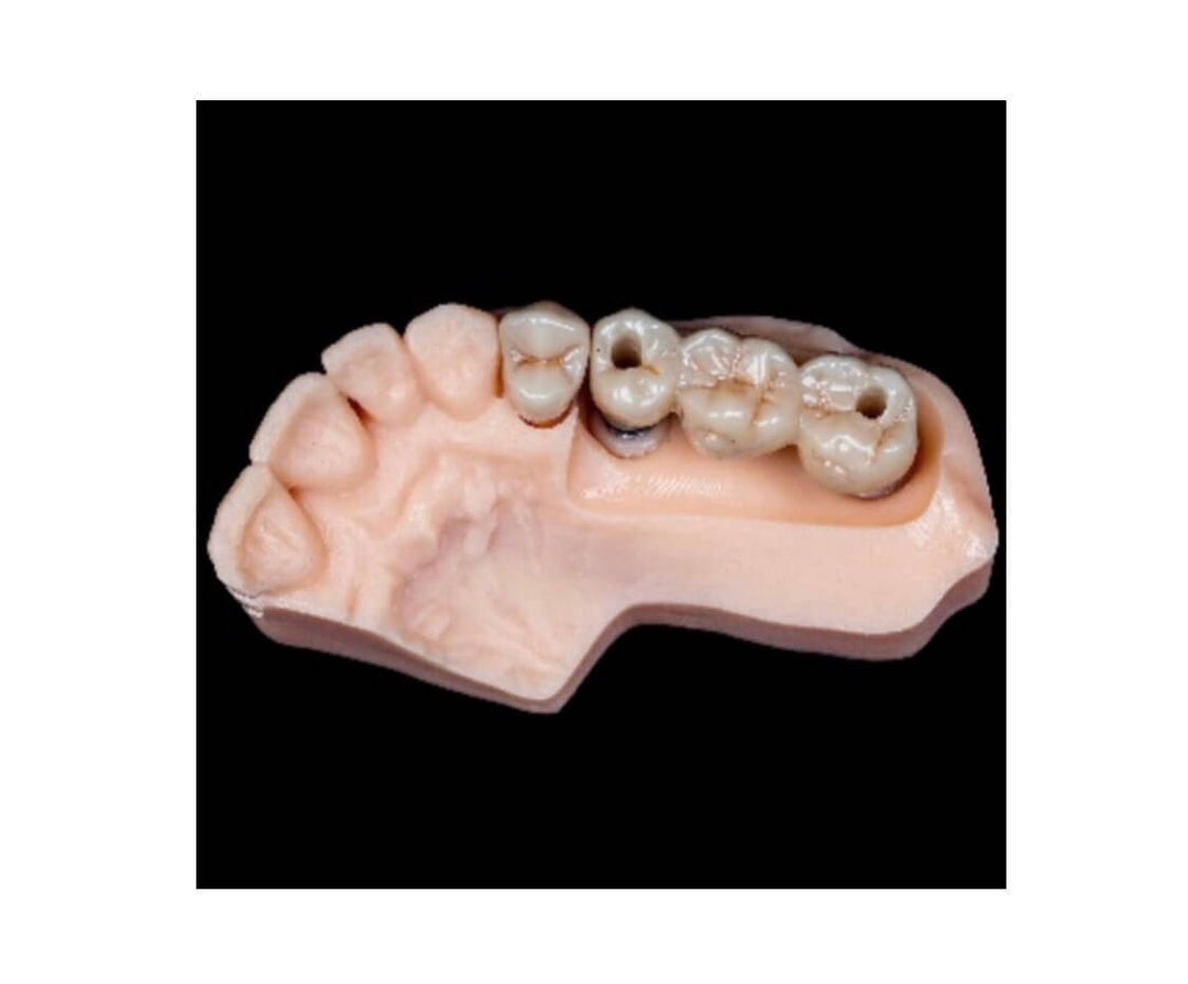 IMPLANT RESTORATIONS IN TEETH POSTERIOR AREA