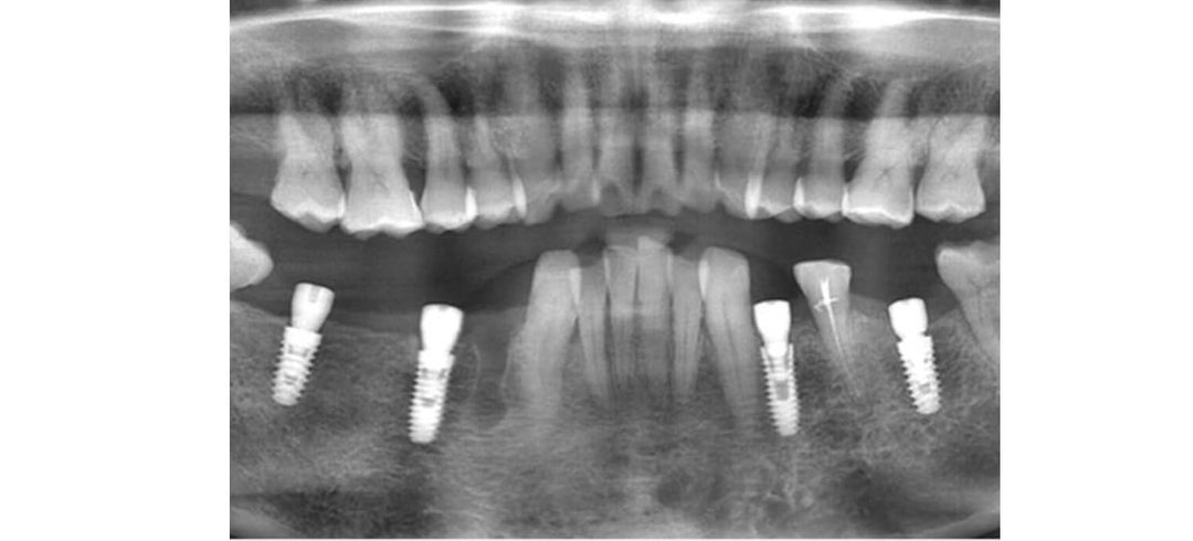 IMPLANT SURGERY WITH THE APPLICATION OF SURGICAL GUID