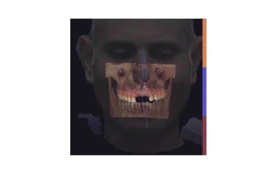FACIALLY DRIVEN IMPLANT IN THE AESTHETIC ZONE