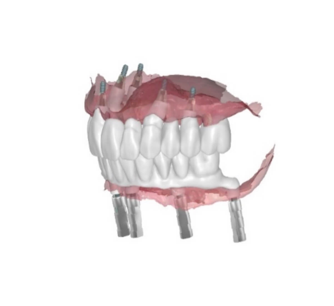 RECONSTRUCTION OF FULL MOUTH OCCLUSION WITH ALL-ON-FIVE IMPLANT TREATMENT