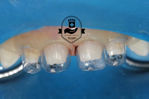 3M™ Strip crown forms - pediatric anterior set