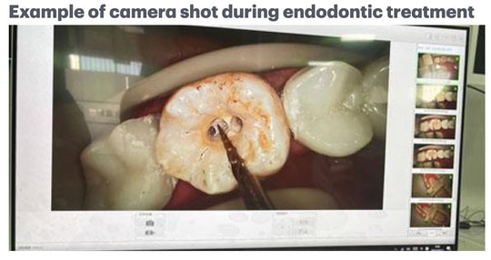 ADAE endodontic micro camera-New release