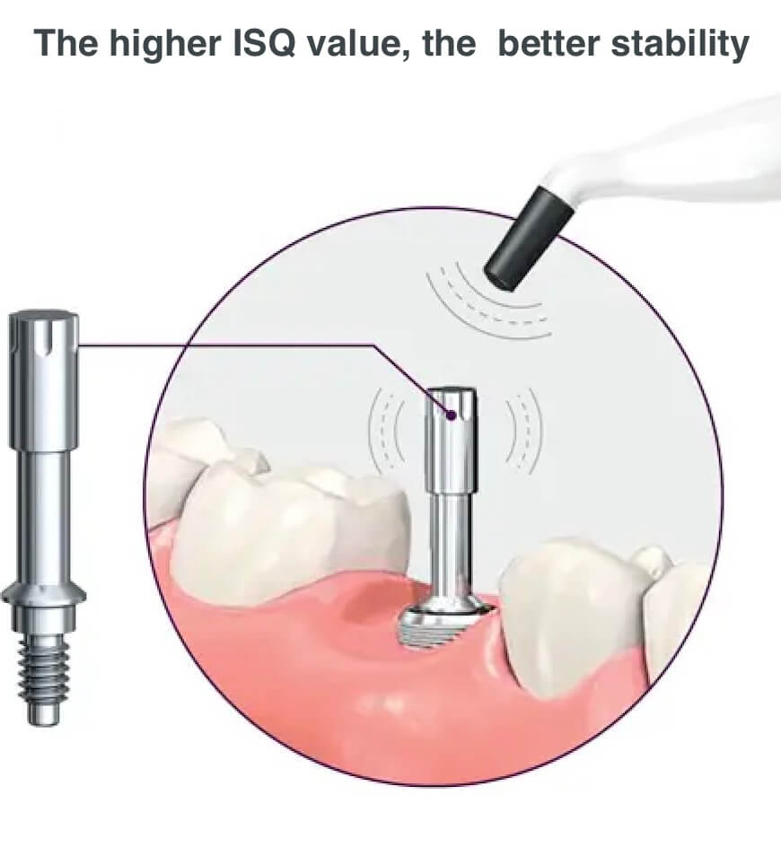 ADAE AD50 Dental Implant Stability Meter