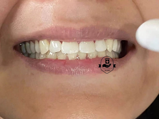 ADAE Dental Glass Ceramic Emax - ADAE Dental Online Store