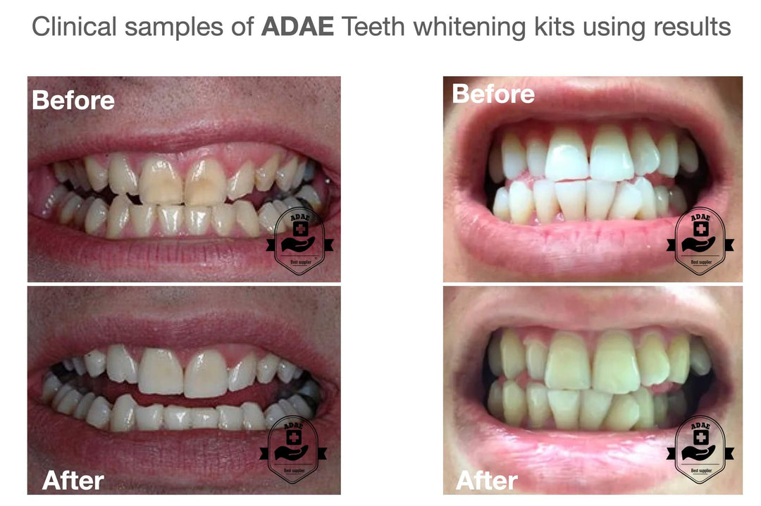 Teeth whitening Osram light AD013 - ADAE Dental Online Store