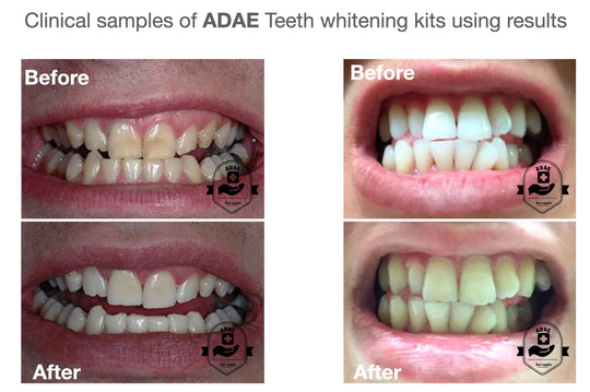 Teeth whitening Osram light AD013 - ADAE Dental Online Store