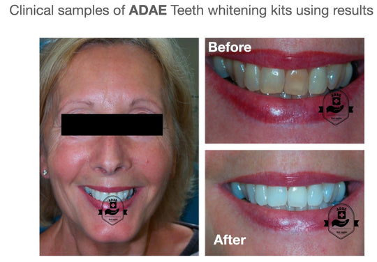 AD005 professional teeth whitening kit for dental clinics