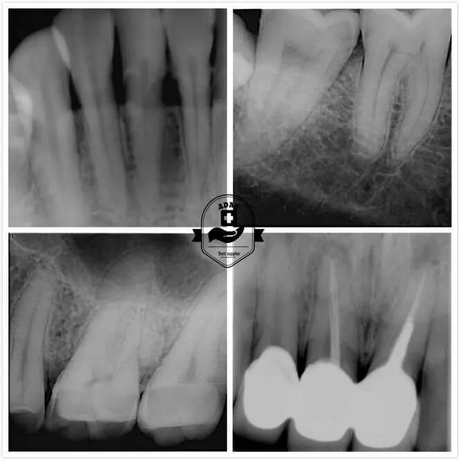 Upgraded ADAE dental portable X-ray machine