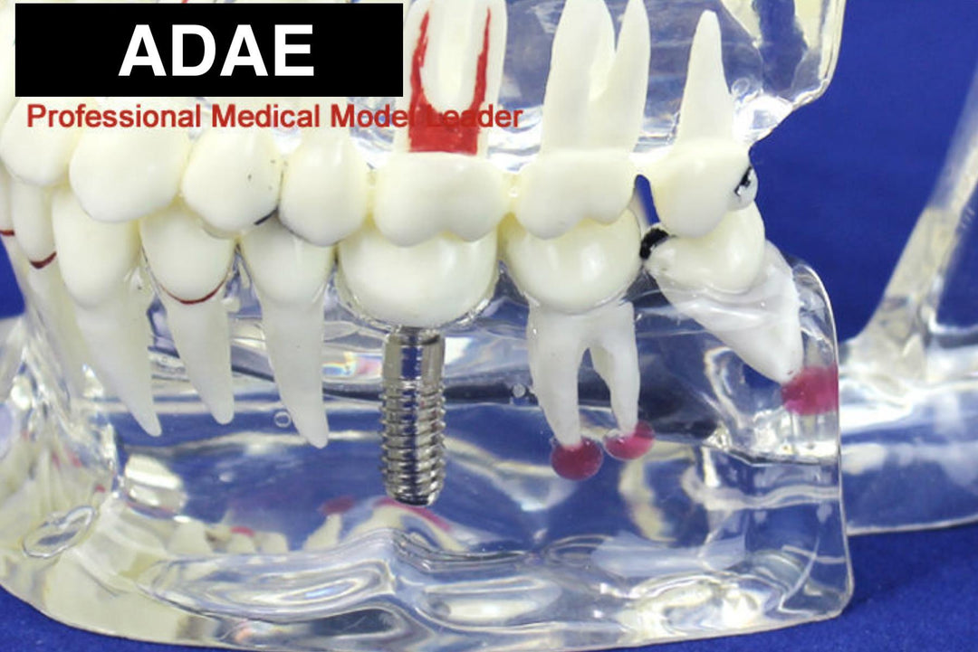 ADAE AD018 transparent dental pathological illustration model with implant tooth - ADAE Dental Online Store
