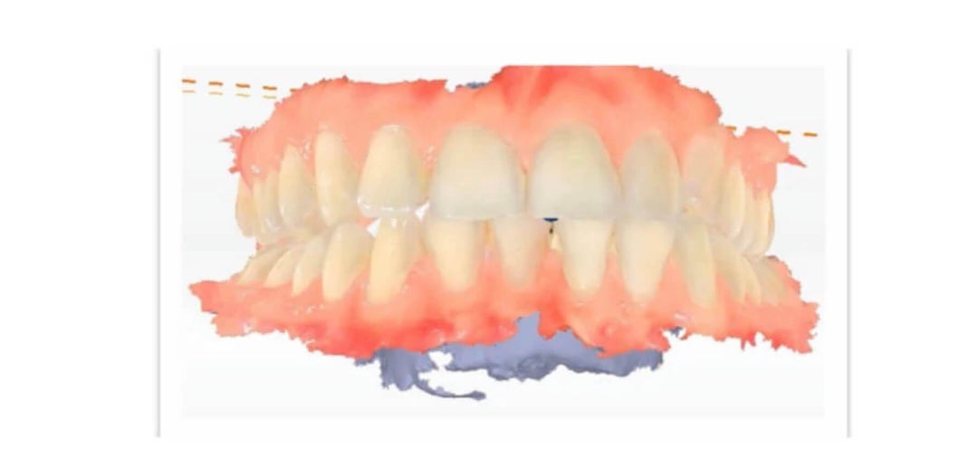 DIGITAL WORKFLOW WITH METISMILE JAW MOTION UPDATE FOR DIAGNOSIS AND MANAGEMENT OF TEMPOROMANDIBULAR JOINT DYSFUNCTION: A CASE REPORT