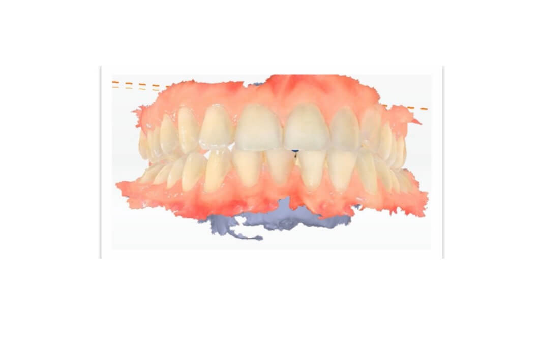 DIGITAL WORKFLOW WITH METISMILE JAW MOTION UPDATE FOR DIAGNOSIS AND MANAGEMENT OF TEMPOROMANDIBULAR JOINT DYSFUNCTION: A CASE REPORT