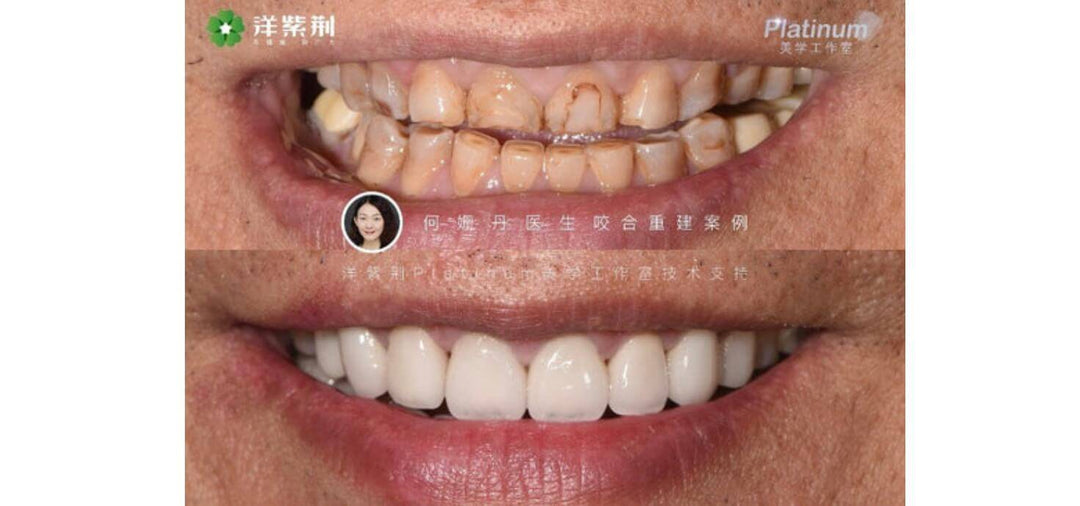 OCCLUSAL RECONSTRUCTION