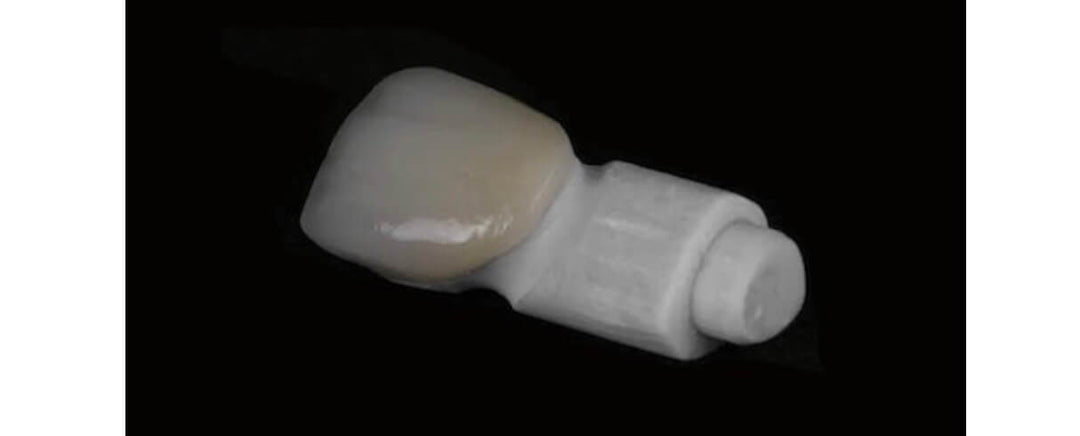 REFRACTORY FELDSPATHIC VENEERS: INTEGRATION BETWEEN TRADITIONAL AND DIGITAL WORKFLOW