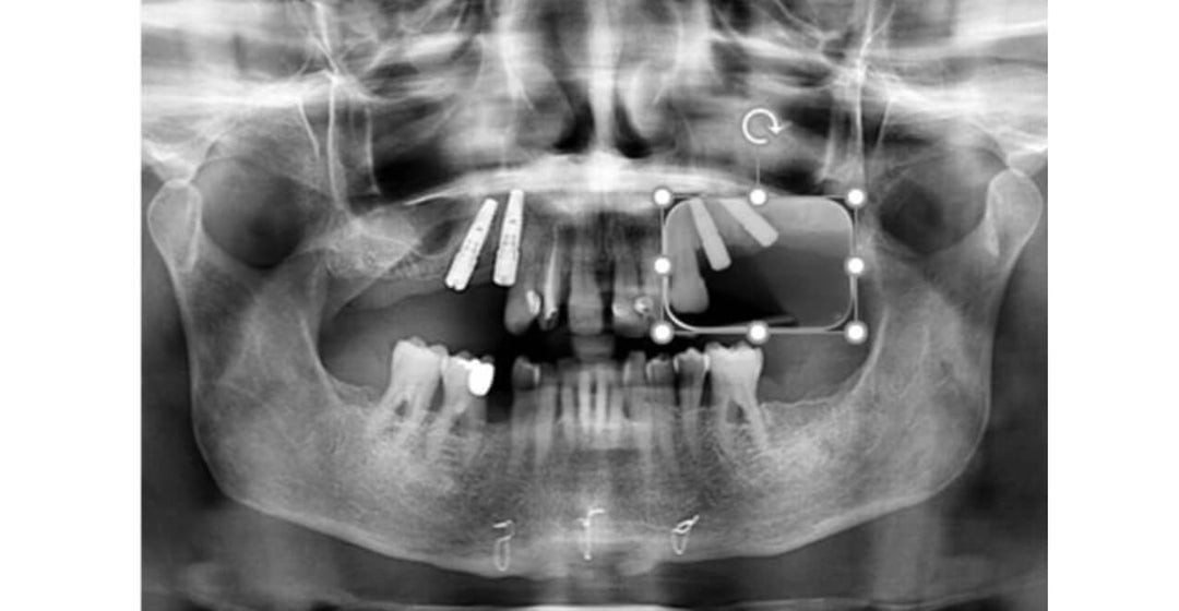 GUIDED IMPLANTOLOGY WITH FULL IN-HOUSE DIGITAL WORKFLOW