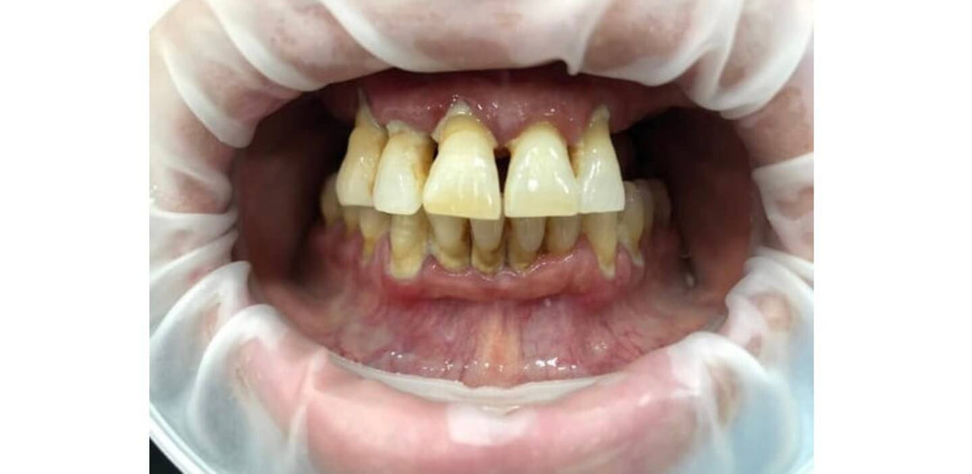 FULL DIGITAL CASE FOR IMPLANT-BASED RESTORATION