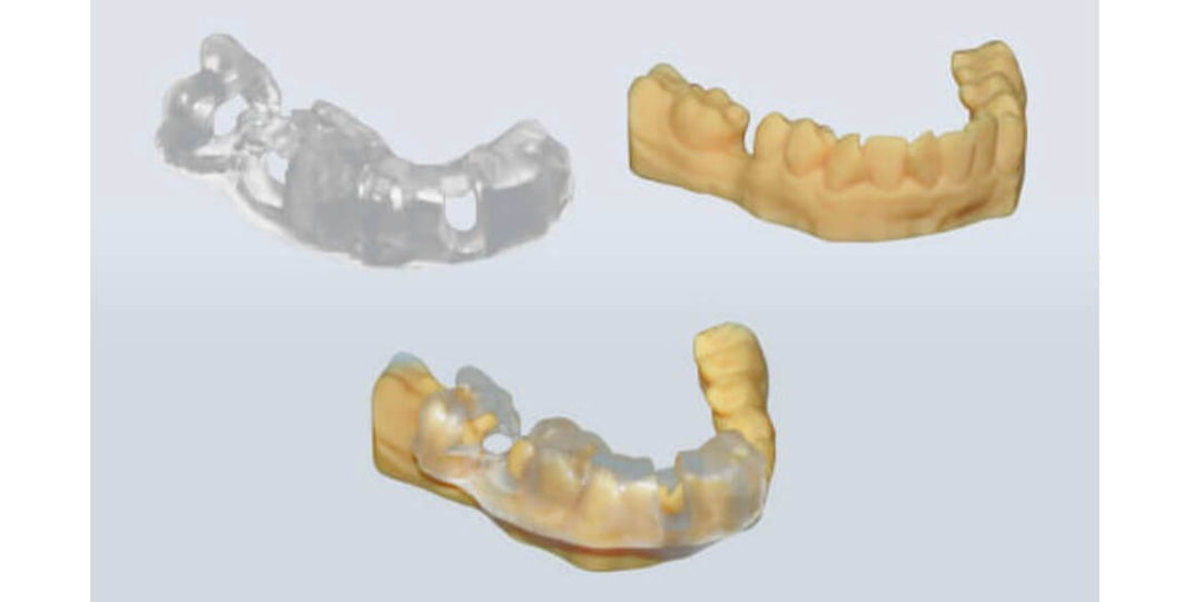 NARROW DIAMETER IMPLANT IN POSTERIOR MANDIBLE