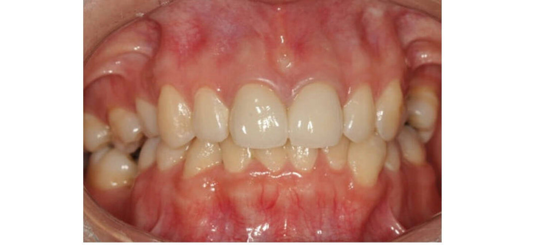 IMPLANTOLOGY BETWEEN NARROW POSTERIOR TEETH