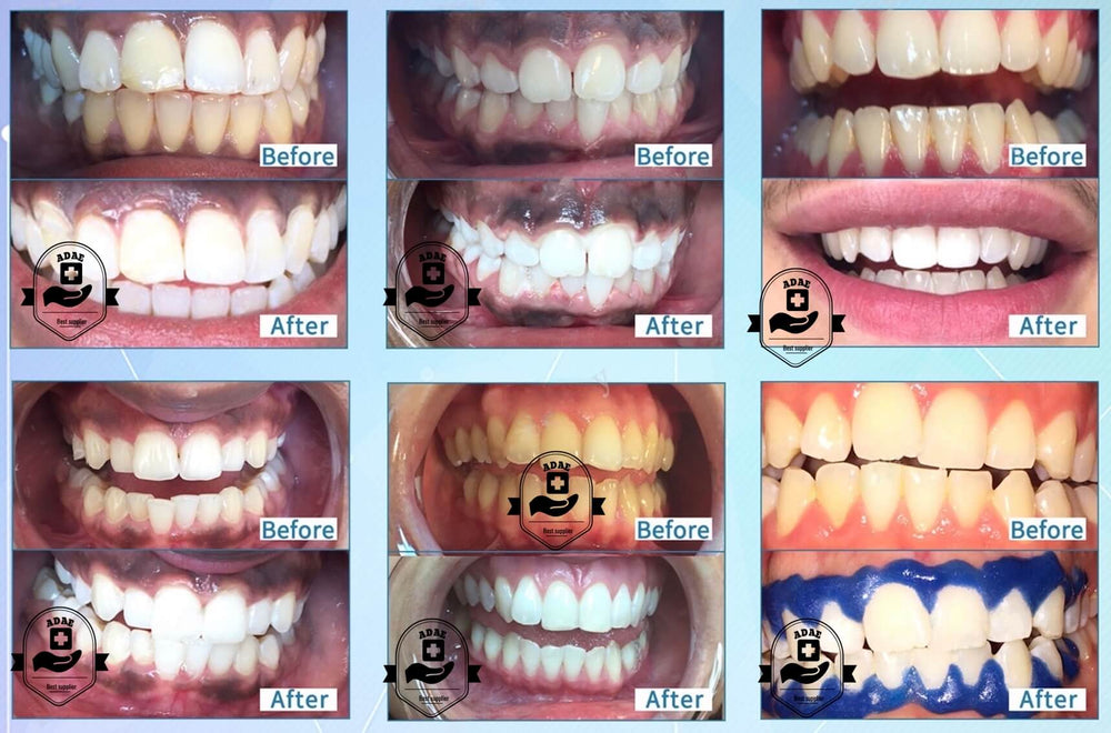 ADAE Smart Pro teeth whitening unit-New release