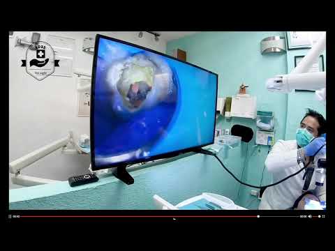 ADAE professional dental microscope with HD1600 (Upgraded version)