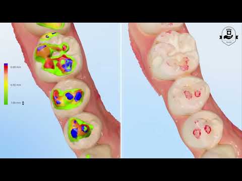 Shining 3D Aoralscan Elf intraoral scanner-New Release